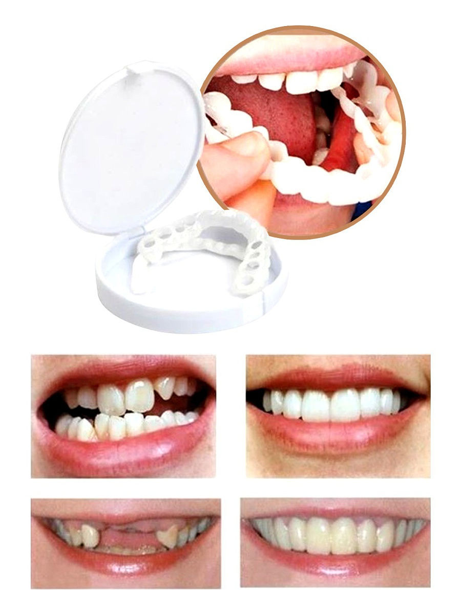 Сложности виниринга нижних зубов